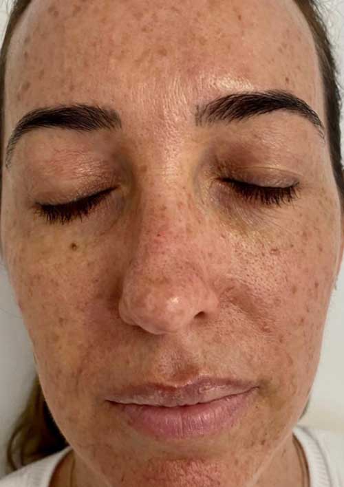 pigmentation before