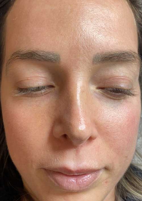 Rosacea after