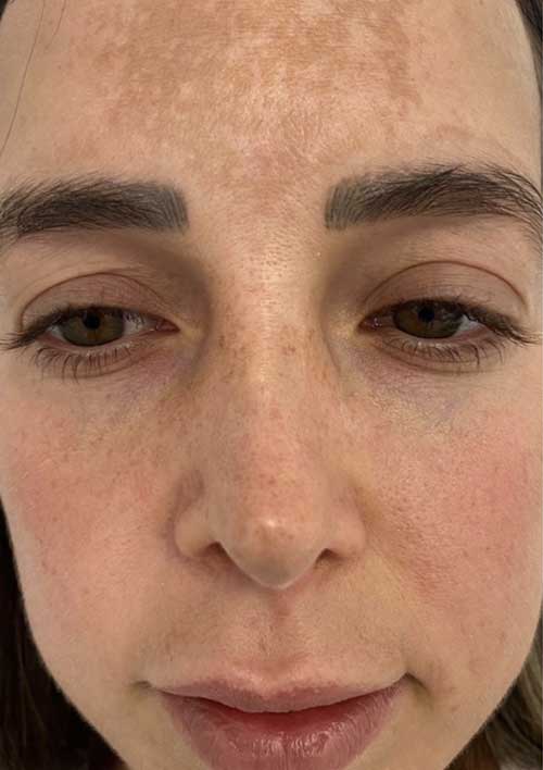 Rosacea before