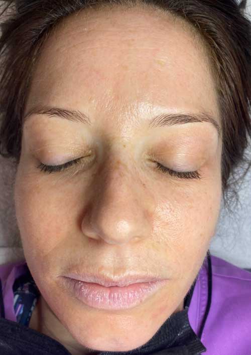 pigmentation after treatment results