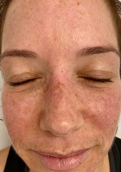 pigmentation before treatment