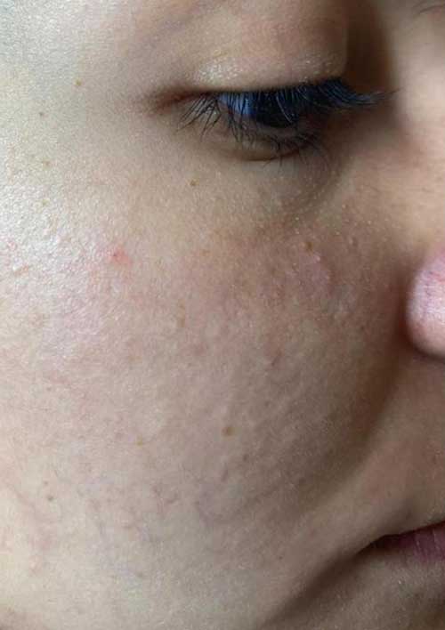 skin texture