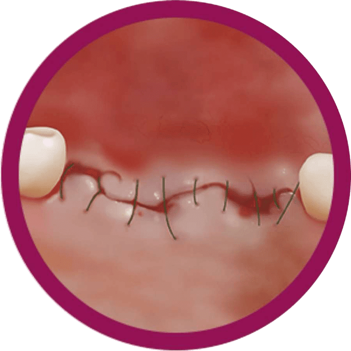 implantes