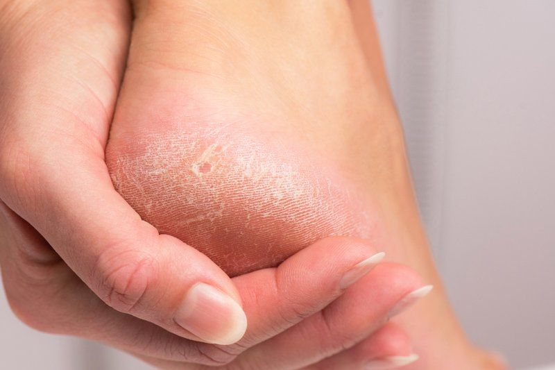 Calluses On Feet — Norwich, CT — Eastern CT Foot Specialists