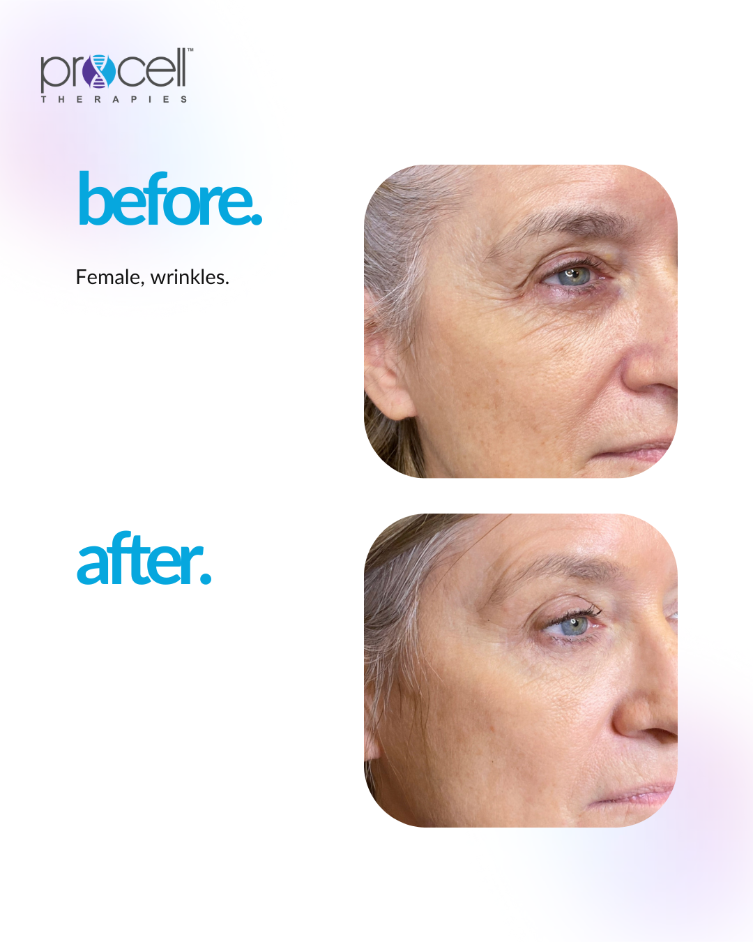 Side-by-side photos show a woman's face before and after a facial treatment, with fewer wrinkles in the 