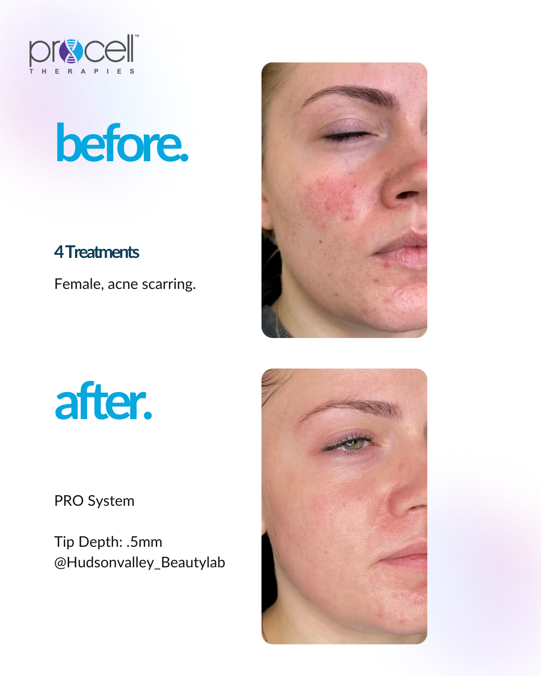 Comparison: facial acne before and after 4 treatments.  Improved skin, less redness after.