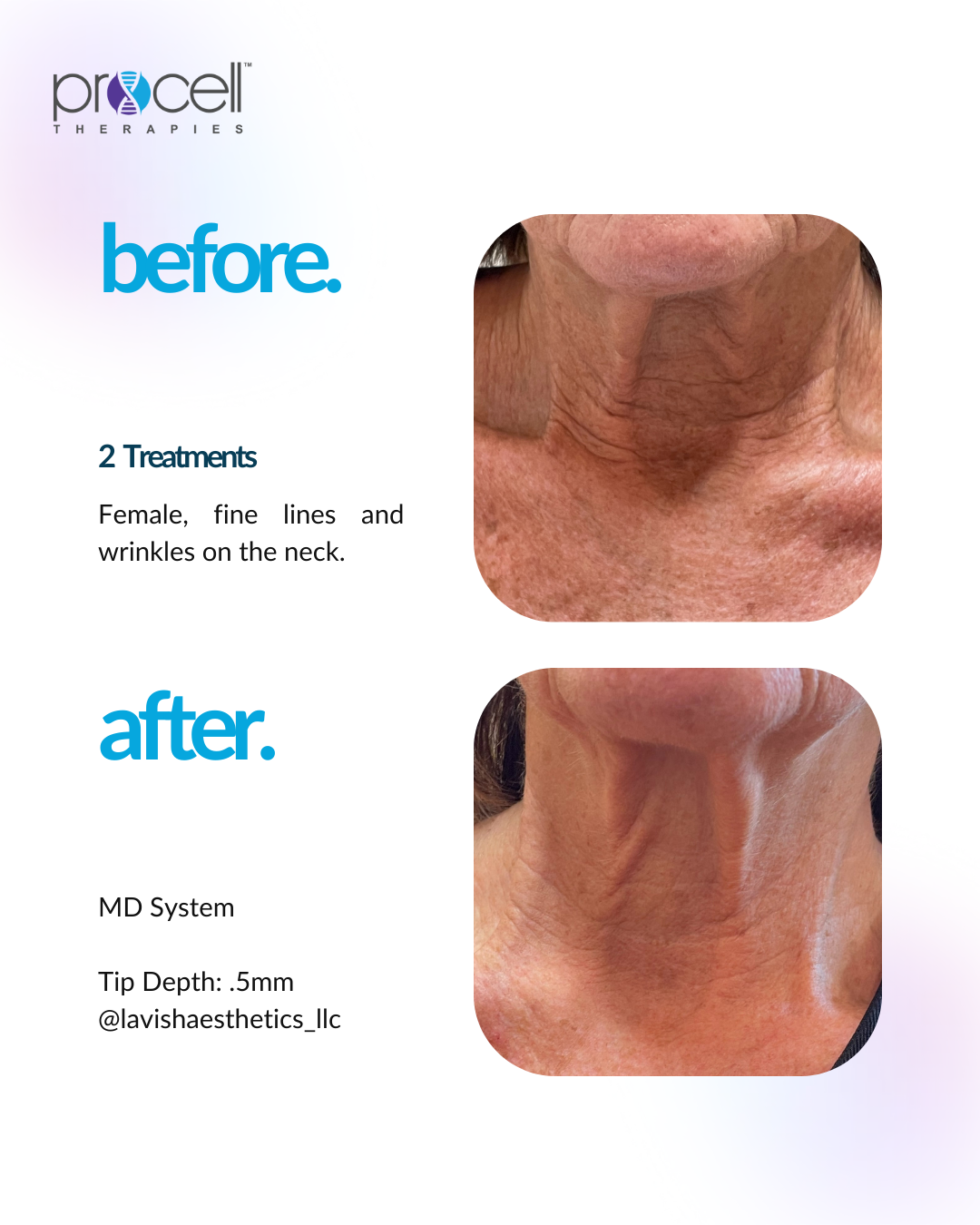 Before and after photos of a woman's neck, showing reduced fine lines and wrinkles after two treatments.