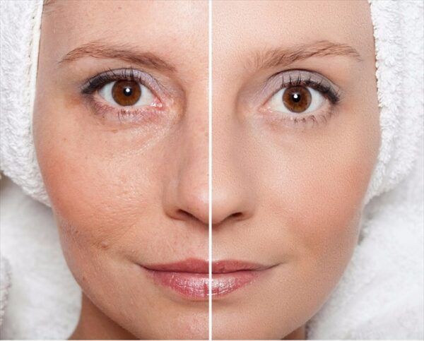 Vampire Facial Treatment Result — Savannah, GA — E’Lan Vital Medical Spa