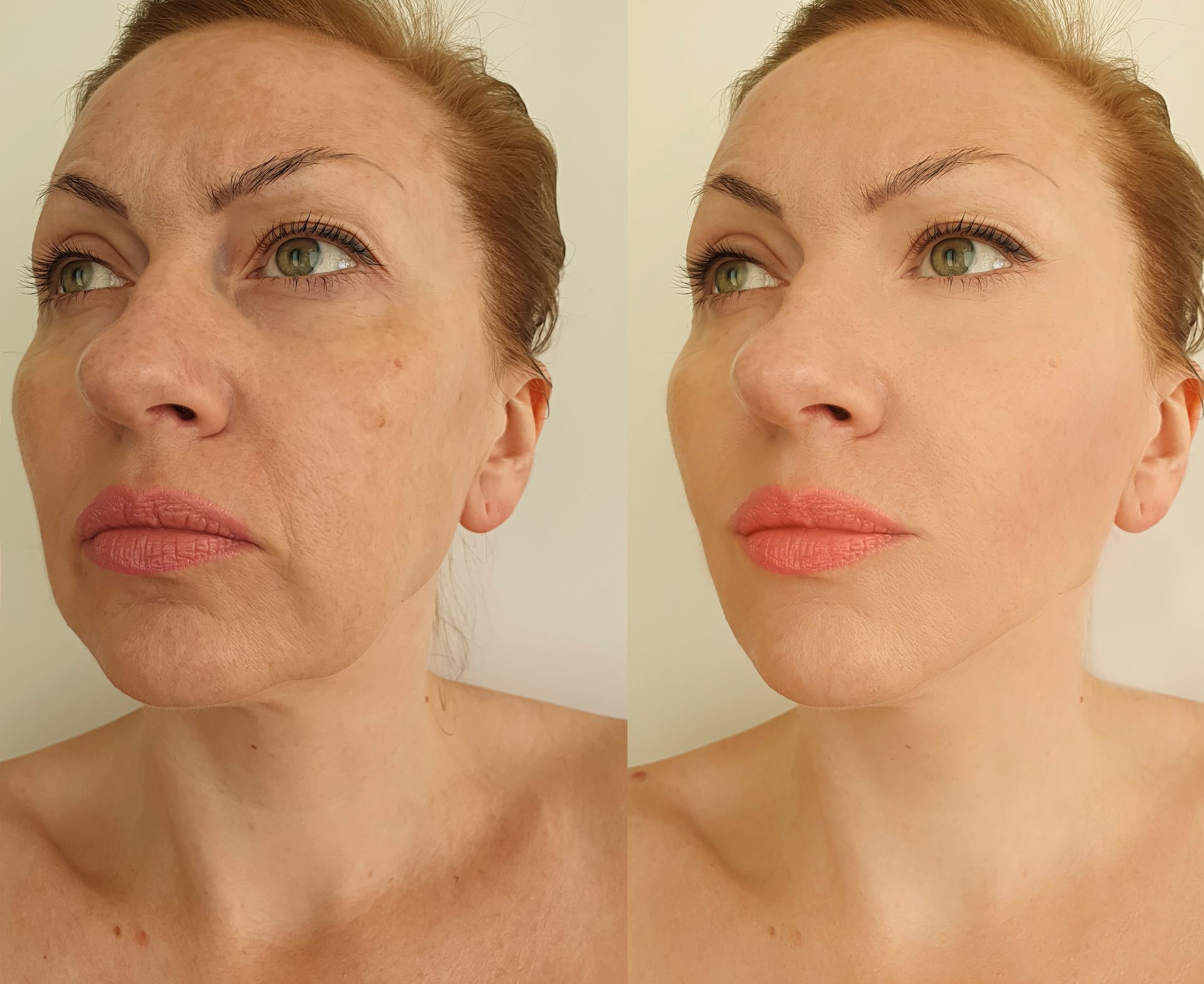 Old Woman Before And After Facial — Savannah, GA — E’Lan Vital Medical Spa