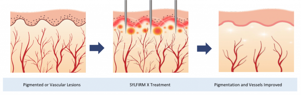 Sylfirm Treatment — Savannah, GA — E’Lan Vital Medical Spa