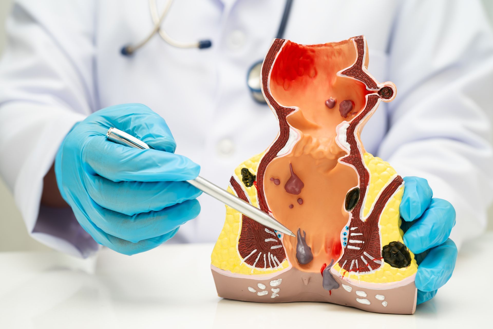 Asian doctor with rectum and hemorrhoid human anatomy model at hospital, inflamed vascular structure.