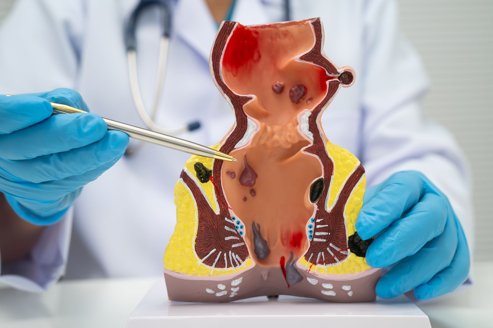 A doctor is explaining a model of a rectum and anus anatomy.