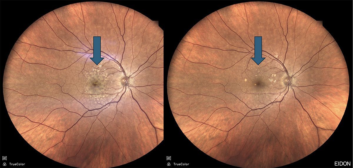 58 yo woman with high-risk intermediate AMD