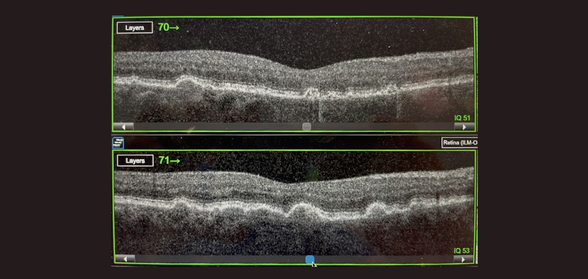 70 yo woman with high-risk intermediate AMD