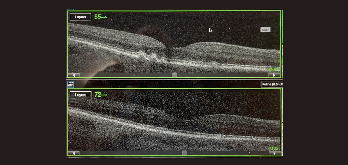 68 yo woman with high-risk intermediate AMD
