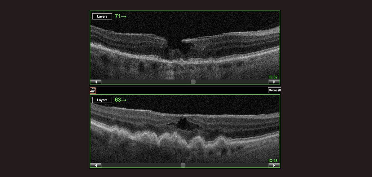 79 yo woman with chronic Lamellar macular hole and High-risk intermediate AMD