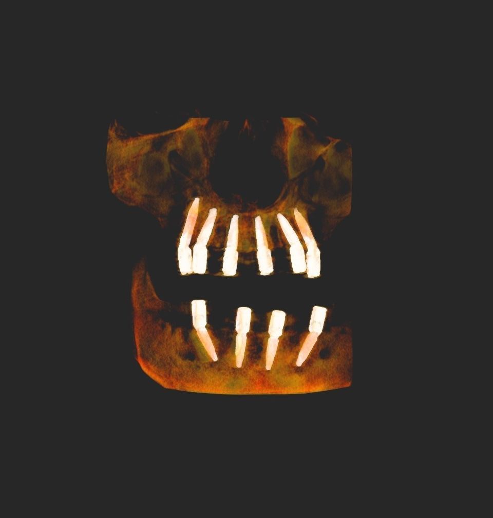Radiograph of a skull showing six implants for the top arch.