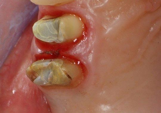 Primo piano di due denti danneggiati con scolorimento giallastro e gengive rosse e infiammate.