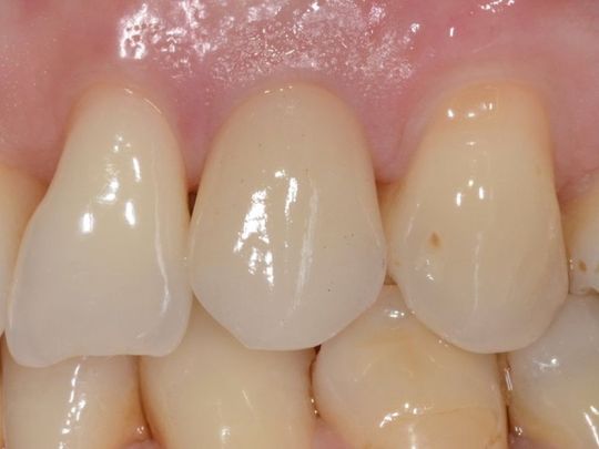 Primo piano dei denti frontali superiori con smalto naturale e gengive rosa.