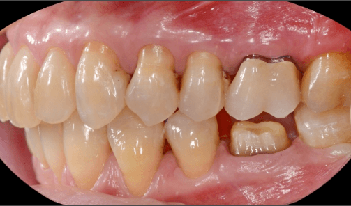 Primo piano di denti con un dente inferiore mancante e usura dentale visibile.