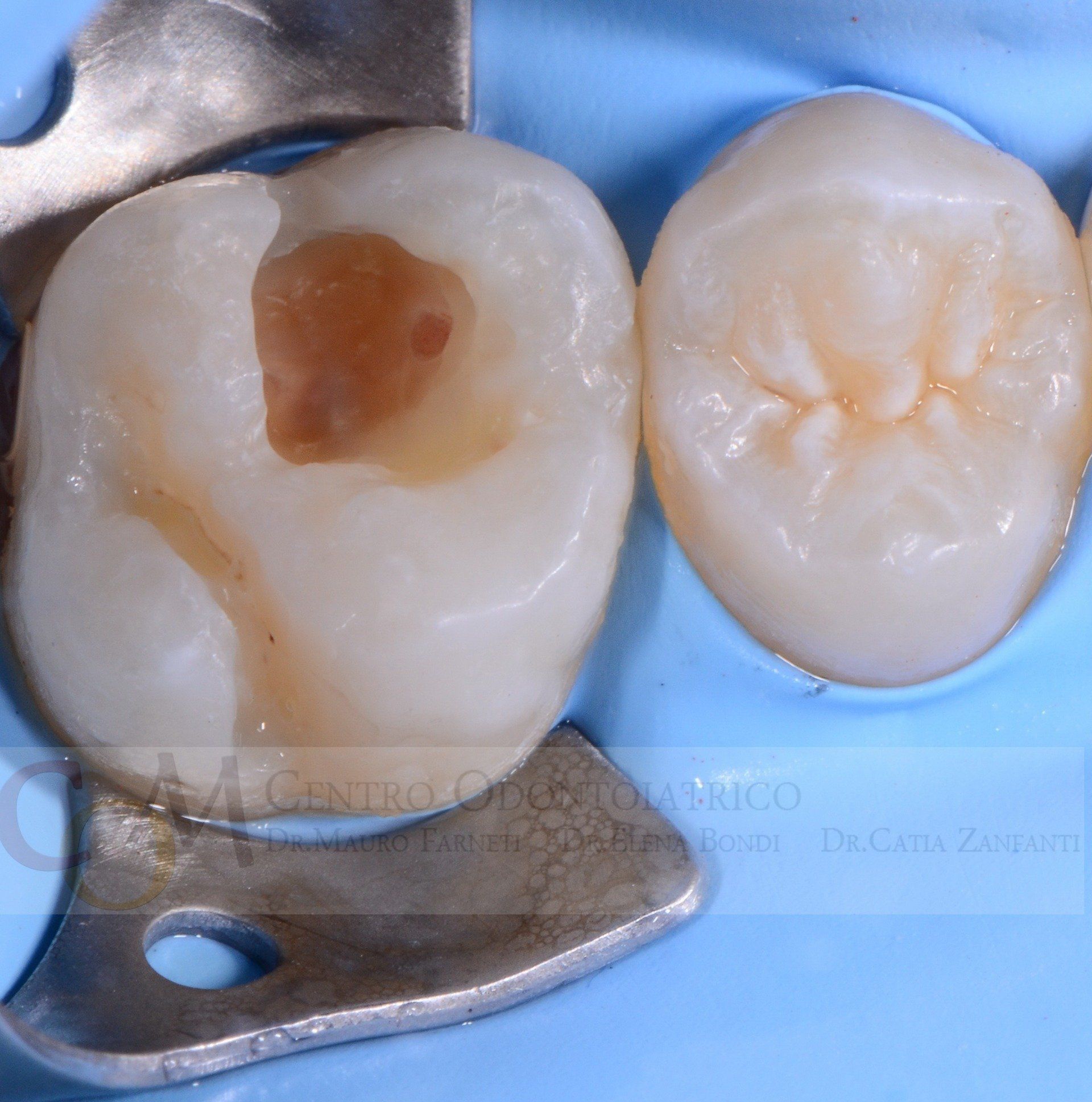 Due corone dentali su superficie blu, una delle quali mostra l'apertura di una cavità marrone
