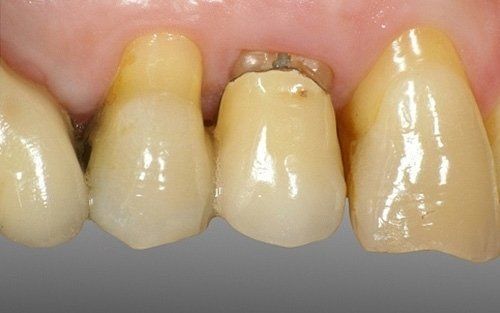 Primo piano dei denti frontali superiori con ingiallimento e corona dentale visibile.