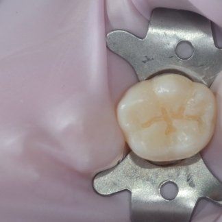Primo piano di un molare tenuto da una pinza dentale metallica, che mostra una corona bianca con una colorazione giallastra.