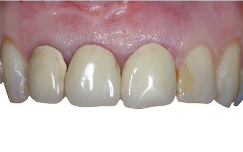 Primo piano dei denti frontali superiori con evidente scolorimento e spazi tra le gengive.
