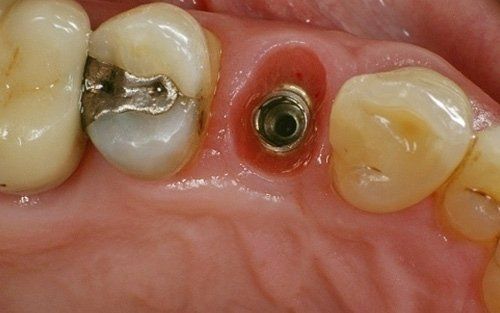 Primo piano delle gengive con un perno di impianto dentale tra i denti e un'otturazione in amalgama d'argento nelle vicinanze.
