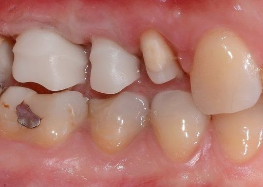 Primo piano di denti da latte storti, tra cui un dente inferiore rotto con una carie scura.