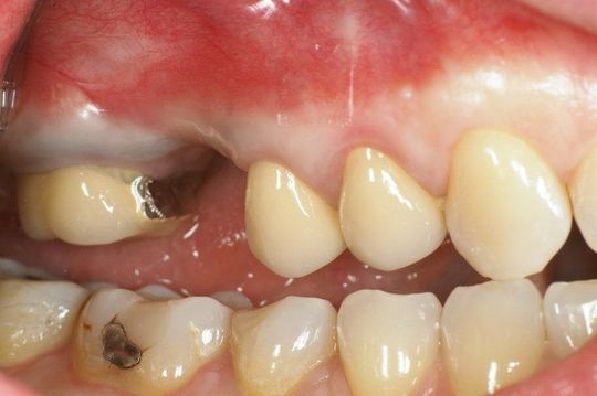 Primo piano di denti con grave ingiallimento e carie, comprese cavità scure vicino alle gengive.