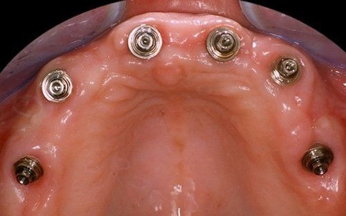 Palato superiore con sei impianti dentali visibili nel tessuto gengivale rosa.