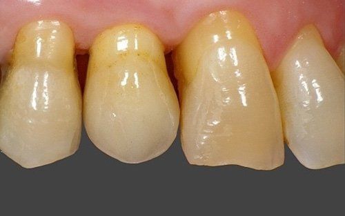 Primo piano di quattro denti frontali scoloriti con macchie giallastre su gengive rosa.