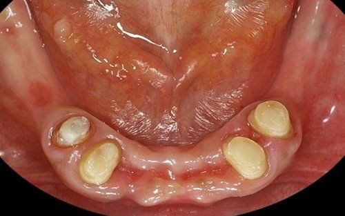 Primo piano del palato inferiore e quattro piccole strutture gialle simili a denti in una bocca