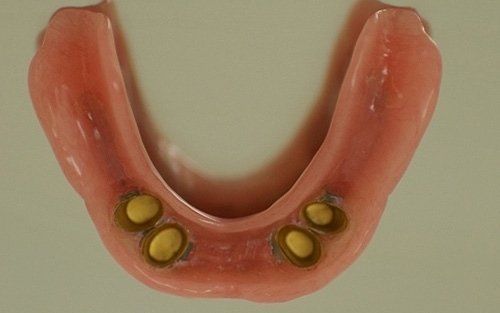 Stampo dentale rosa a forma di U con quattro inserti dorati simili a otturazioni su sfondo beige.
