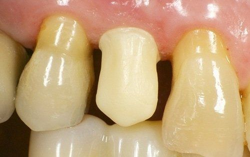 Primo piano dei denti frontali con una corona dentale di colore chiaro tra denti naturali ingialliti.