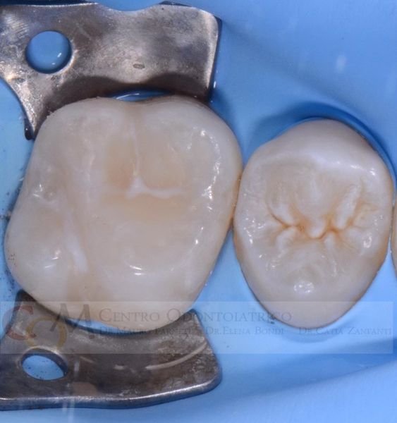 Due denti isolati da una diga di gomma blu e da un morsetto metallico, uno dei quali presenta una scanalatura incrinata visibile.