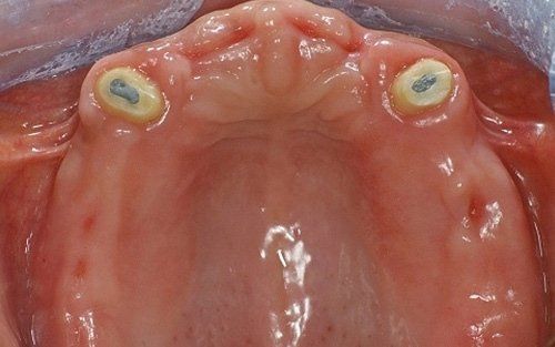 Primo piano della bocca di un gatto con due oggetti circolari blu e gialli vicino alle gengive superiori.