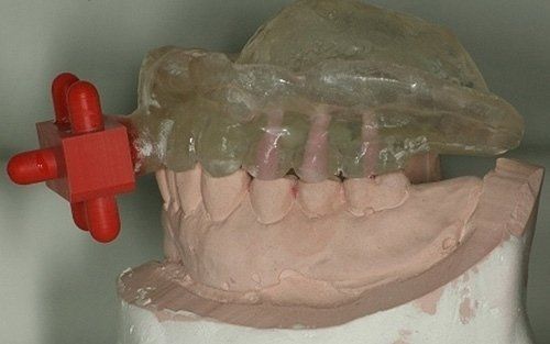 Modello dentale con protezione trasparente per i denti superiori e manopola di regolazione rossa su una mascella beige.