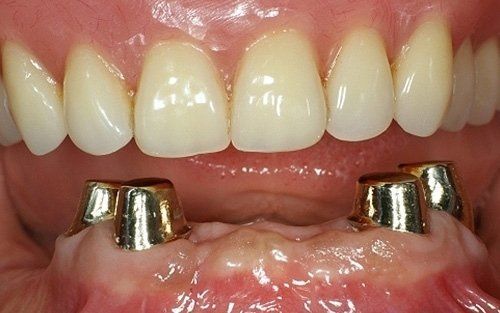 Primo piano dei denti superiori e degli impianti dentali inferiori con perni metallici lucidi in bocca