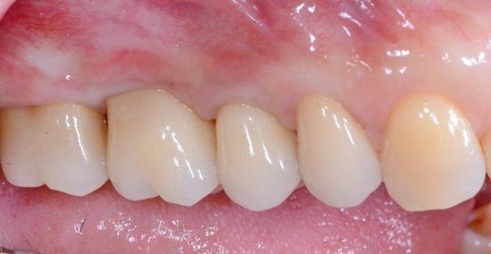 Primo piano dei denti incisivi superiori e delle gengive rosa con una zona arrossata e irritata visibile sopra i denti.
