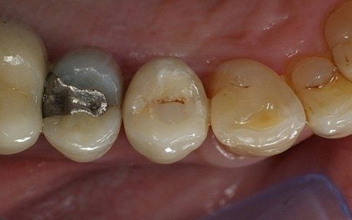 Primo piano di denti con otturazione in amalgama d'argento e lieve scolorimento dello smalto.