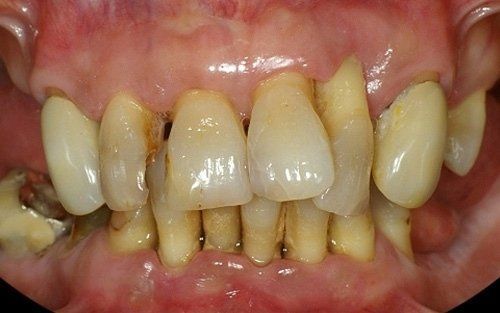 Primo piano di denti gravemente affollati e scoloriti, con spazi vuoti e recessione gengivale.