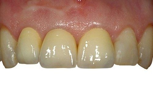 Primo piano dei denti frontali superiori e delle gengive, che mostrano denti leggermente ingialliti con un bordo gengivale rosato.