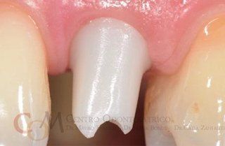 Primo piano di una corona dentale bianca su impianto tra due denti e gengive rosa.