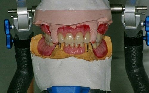 Calco dentale in un articolatore, che mostra i denti superiori e inferiori con materiale gengivale rosa