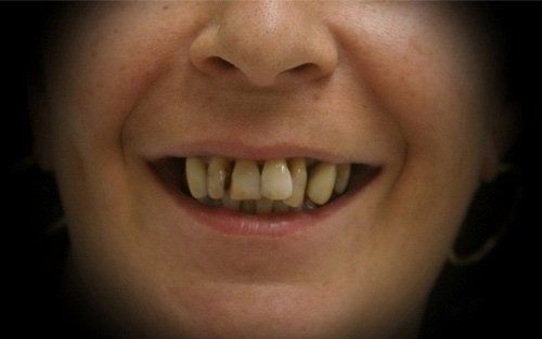Primo piano di una bocca sorridente con denti irregolari su sfondo scuro.