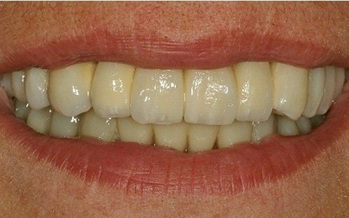 Primo piano di una bocca sorridente che mostra denti bianchi e labbra rosa