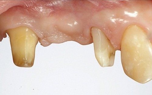 Primo piano di denti e gengive superiori danneggiati, con diversi denti frontali mancanti.