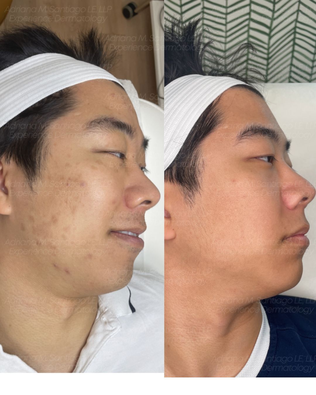 Side-by-side profile photos of the same person lying down before and after a facial change